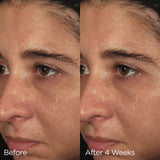 ORMEDIC balancing biopeptide crème before and after results
