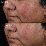 AGELESS+ retinol 0.75% before and after 8 weeks