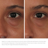 ORMEDIC eye lift gel before and after results