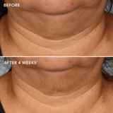 the MAX neck lift before and after results